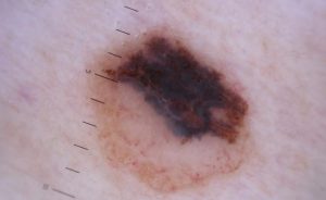 Melanoma: o papel da cirurgia plástica no tratamento do câncer